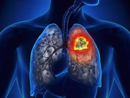 Ung thư phổi là gì? Cách nhận biết và phòng ngừa ung thư phổi?